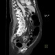 Diverticulitis of sigmoid colon, fistula, abscess: CT - Computed tomography